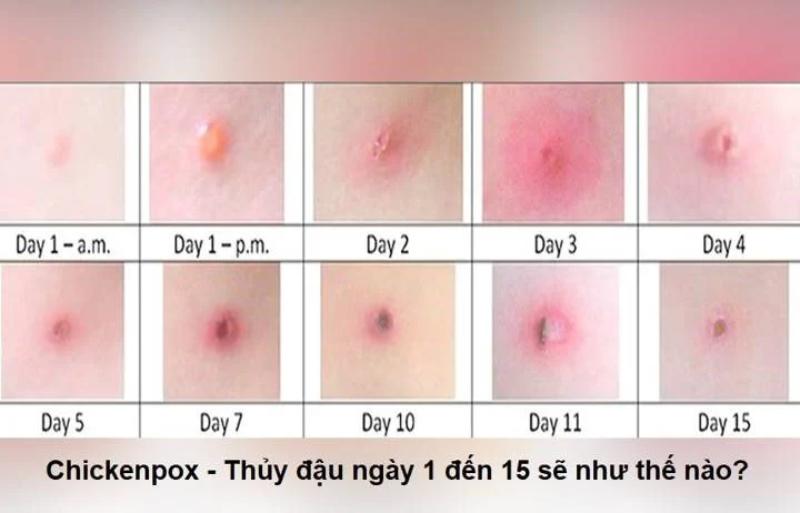 Mách phụ huynh phác đồ chữa bệnh thủy đậu ở trẻ nhỏ hiệu quả